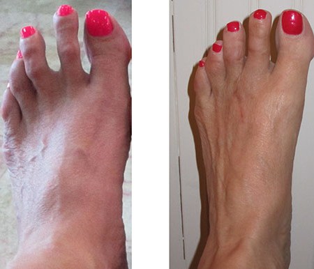 Left Foot before and After Surgery