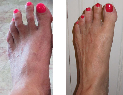 Left Foot before and After Surgery