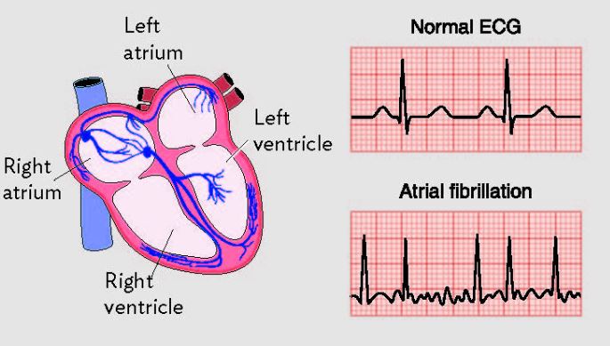afib