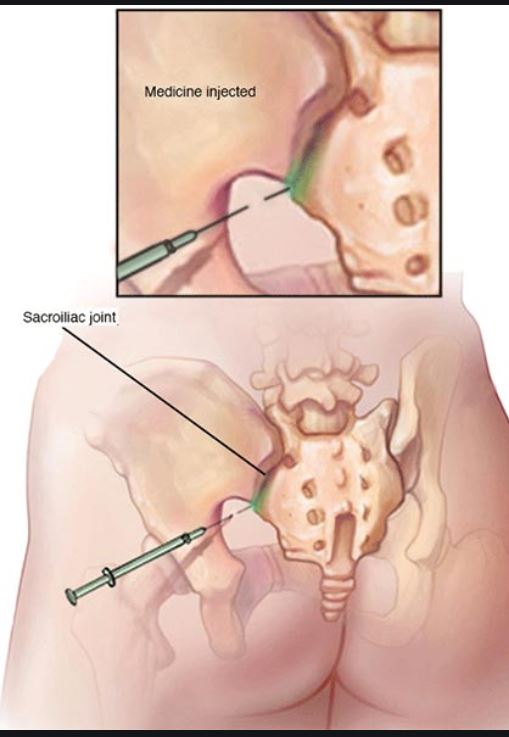 sacroiliac joint